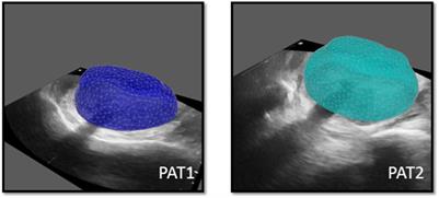 Personalised in silico biomechanical modelling towards the optimisation of high dose-rate brachytherapy planning and treatment against prostate cancer